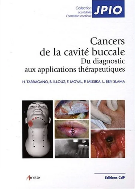 CANCERS DE LA CAVITÉ BUCCALE : DU DIAGNOSTIC AUX APPLICATIONS THÉRAPEUTIQUES