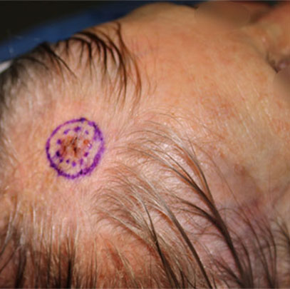 Carcinome basocellulaire du cuir chevelu