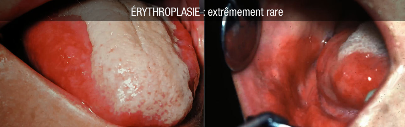 erythroplasie