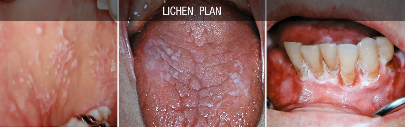 lichen plan
